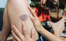 Loại đồ uống cần tránh ngay vì có thể dẫn đến cục máu đông đe dọa tính mạng