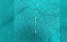 Ký sinh trùng dài 12cm chui vào má người phụ nữ sau khi bị muỗi đốt