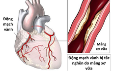 Các dấu hiệu nhận biết bệnh nhồi máu cơ tim cấp