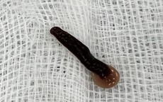 Người đàn ông uống nước suối bị con đỉa dài 5cm chui vào mũi