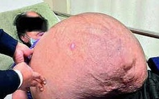 Người phụ nữ vào viện với cái bụng to như mang đa thai, thực tế là "quái vật" đeo đẳng suốt 18 năm khiến bác sĩ cũng "toát mồ hôi"