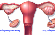 Đau bụng âm ỉ, bác sĩ khuyến cáo chị em có 1 trong 4 dấu hiệu này tuyệt đối không chủ quan!