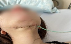 Trải lòng của cô gái 25 tuổi bị hoại tử nặng vùng cổ sau khi tiêm thuốc tan mỡ nọng cằm: "Có lúc em không muốn sống nữa!"