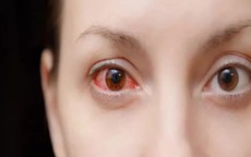 Cảnh báo 5 dấu hiệu nhiễm trùng mắt liên quan đến COVID-19