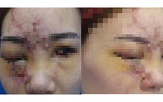 Cô gái 27 tuổi mất thị lực sau khi tiêm filler làm đầy rãnh má tại tiệm tóc