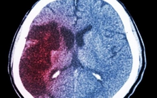 Xuất huyết não “giết người nhanh nhất”, 4 dấu hiệu trước khi khởi phát nhưng dễ bị bỏ qua
