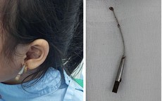 Kinh hãi bé gái 6 tuổi bị que lấy ráy tai đâm xuyên vào tai giữa, bài học cho nhiều gia đình!