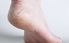 4 sai lầm khiến gót chân bạn luôn khô nứt nẻ, nên điều chỉnh ngay hôm nay