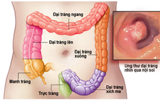 Cảnh báo 5 loại thực phẩm tăng nguy cơ ung thư trực tràng, người Việt hãy dừng ngay hôm nay!