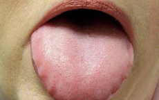 Lưỡi bỗng xuất hiện đốm trắng có thể là dấu hiệu của 3 thứ bệnh