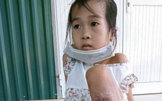 MS 776: Bị rắn độc cắn, bé gái 5 tuổi dân tộc Dao có nguy cơ mất chân khi không có tiền điều trị