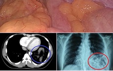 Hy hữu: Đi khám hậu Covid-19, nam thanh niên phát hiện đại tràng chui ngược lên ngực