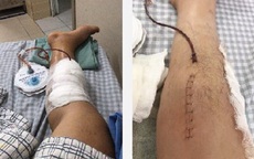 Người đàn ông 32 tuổi suýt mất chân vì sai lầm nhiều người Việt mắc phải
