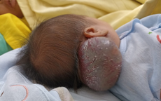Hiếm gặp: Bé sơ sinh 14 ngày tuổi có khối u máu khổng lồ ở vùng cổ gáy