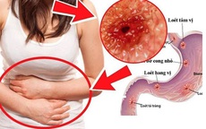 Cảnh giác với 5 nguyên nhân gây ung thư dạ dày, đây là 7 dấu hiệu điển hình cần được khám sớm!