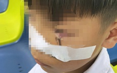 Cấp cứu bé trai 11 tuổi bị lưỡi câu sắc nhọn móc vào mắt khi đùa giỡn