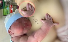Hy hữu: Bé gái chào đời cùng vòng tránh thai của mẹ, chuyên gia lý giải đặt vòng tránh thai vẫn có thể mang thai