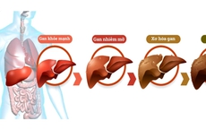 Người bị gan nhiễm mỡ không ăn 5 nhóm thực phẩm này để giảm gánh nặng cho gan!