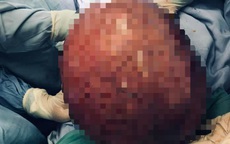 Cứ ngỡ bị béo, cụ bà sững sờ phát hiện có khối u tử cung gần 10kg