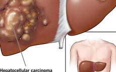 7 nhóm đối tượng cần đi tầm soát ung thư gan sớm