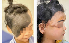 Căn bệnh rất hiếm gặp khiến cô bé có làn 'da trâu' phủ nửa mặt