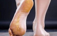Thấy 5 dấu hiệu này ở bàn chân bạn nên chụp CT gan sớm