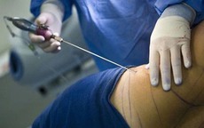 'Tiền mất tật mang' vì hút mỡ bụng tại cơ sở không an toàn