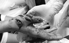 Thiếu nữ 17 tuổi bị máy xay đa năng cắt đứt gân tay