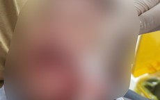 Bé trai 3 tuổi bị chó cắn thương tích nặng