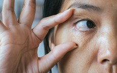 Đột quỵ mắt là gì? Dấu hiệu, nguyên nhân và cách phòng ngừa