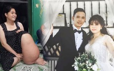 Cô nàng chân voi cưới được chồng đẹp trai như tài tử, theo đuổi 3 năm mới được cái gật đầu