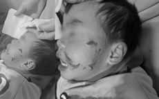Phú Thọ: Bé trai 3 tuổi bị chó hàng xóm cắn ở vùng mặt gây tổn thương