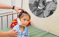 Bé gái 6 tuổi bị đứt tai vì kính vỡ lúc chơi đùa