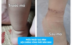 Thấy con có ngấn ở chân, bố mẹ vui mừng tưởng con bụ bẫm, nào ngờ dị tật bẩm sinh