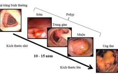 Người đàn ông ở Phú Thọ phát hiện mắc ung thư trực tràng từ một dấu hiệu nhiều người Việt bỏ qua