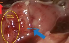 Đau bụng âm ỉ, đau bụng quanh rốn cảnh giác với viêm ruột thừa