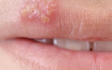 Phòng tránh lây nhiễm Herpes sinh dục