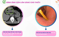 Người đàn ông ở Hải Phòng bị thủng dạ dày, thừa nhận một sai lầm mà nhiều người Việt mắc phải