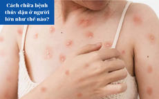 Bệnh thủy đậu ở người lớn, điều trị như thế nào?