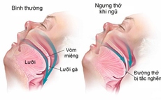 Hay buồn ngủ ban ngày, ngủ ngáy, mệt mỏi khi thức dậy, cần lưu ý hội chứng nguy hiểm này