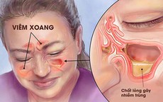 Thời tiết thay đổi, người bị viêm xoang cần làm gì để ngừa tái phát