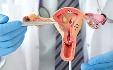 Buồng trứng đa nang ảnh hưởng tới khả năng sinh sản như thế nào?