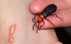 Ăn loại côn trùng được đồn thổi giúp tăng cường sinh lý, người đàn ông đái ra máu, suy thận cấp
