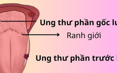 Người bệnh ung thư lưỡi nên tập luyện như thế nào?