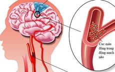 Người phụ nữ ở Cần Thơ bị đột quỵ 2 lần chỉ trong 48h từng có tiền sử mắc căn bệnh này