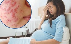 Khắc phục mụn trứng cá ở phụ nữ mang thai