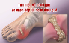 Tìm hiểu về bệnh gút và cách hỗ trợ kiểm soát bệnh