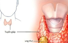 Các dấu hiệu điển hình của ung thư tuyến giáp ai cũng cần biết