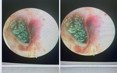 Người đàn ông đau nhức, phải đến viện do sai lầm nhiều người hay mắc khi lấy ráy tai