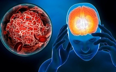 Bác sĩ khuyến cáo cách phòng ngừa đột quỵ trong mùa đông lạnh